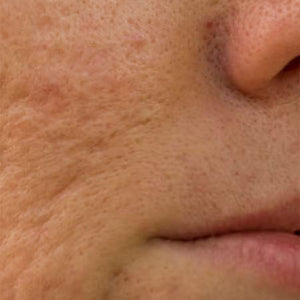 Adult Acne