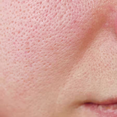 Enlarged Pores