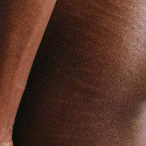 Stretch Marks